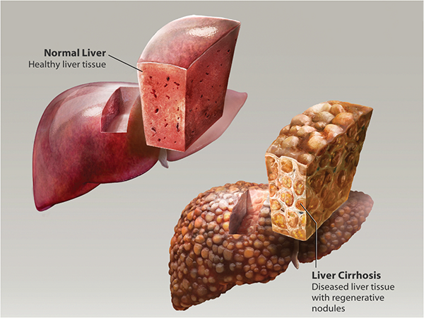 Learning The ABCs: What Is Viral Hepatitis?