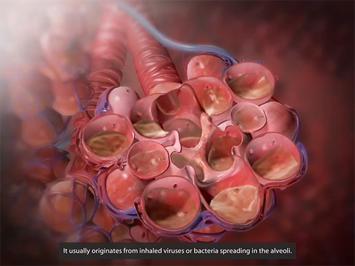 Exploring Lung Pathologies with Physiology & Pathology