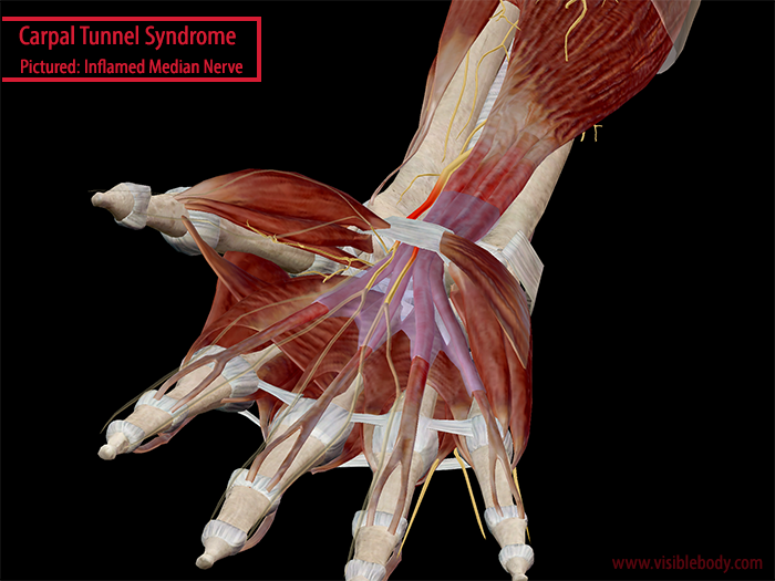 Into The Carpal Tunnel: Anatomy & Pathology of Carpal Tunnel Syndrome