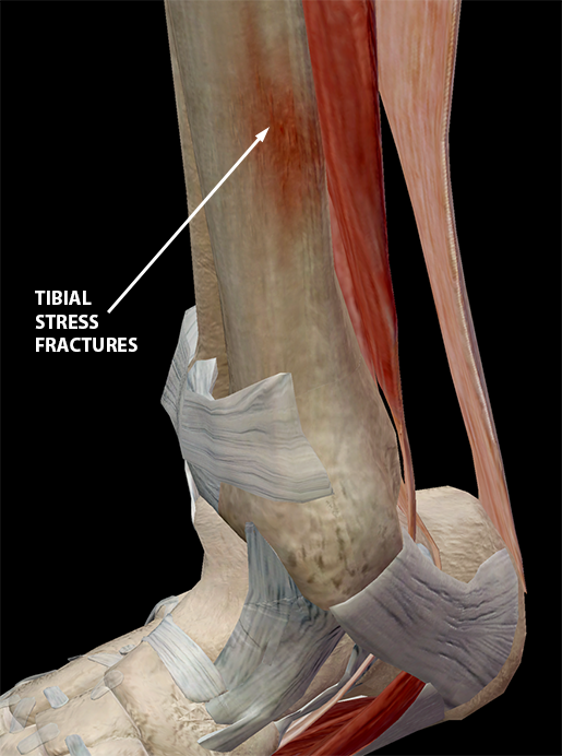 tibial stress fracture