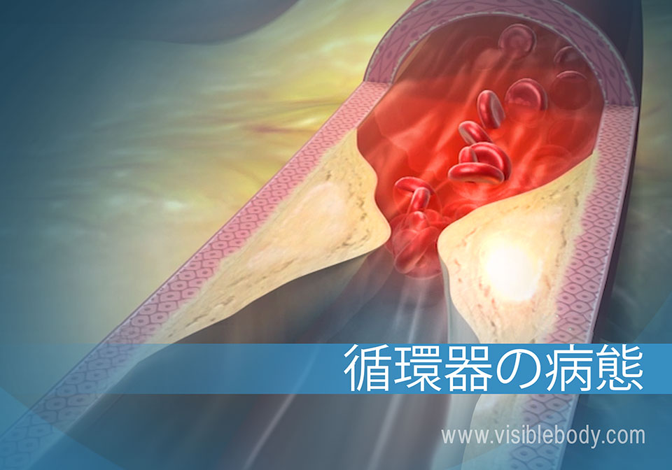 アテローム性動脈硬化と循環器疾患